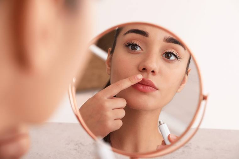 Cold sore or fever blister