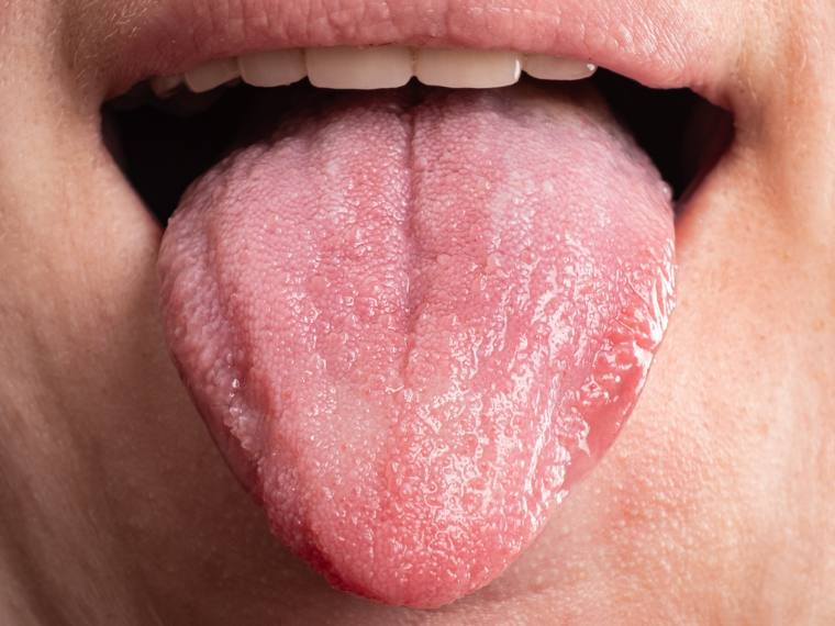 Oral thrush