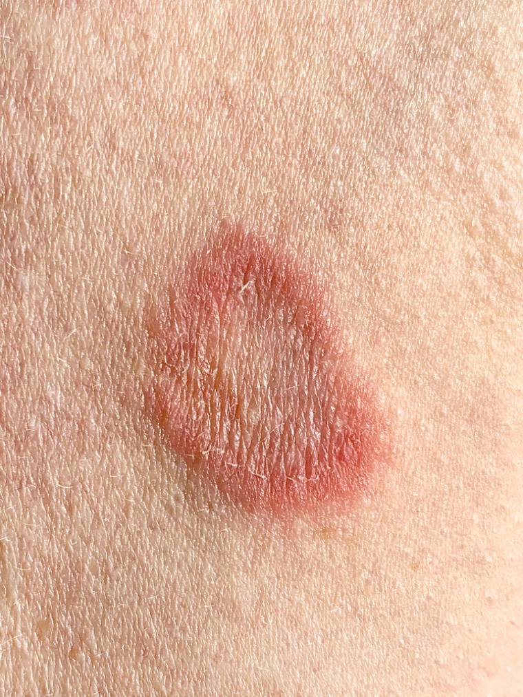 Ringworm