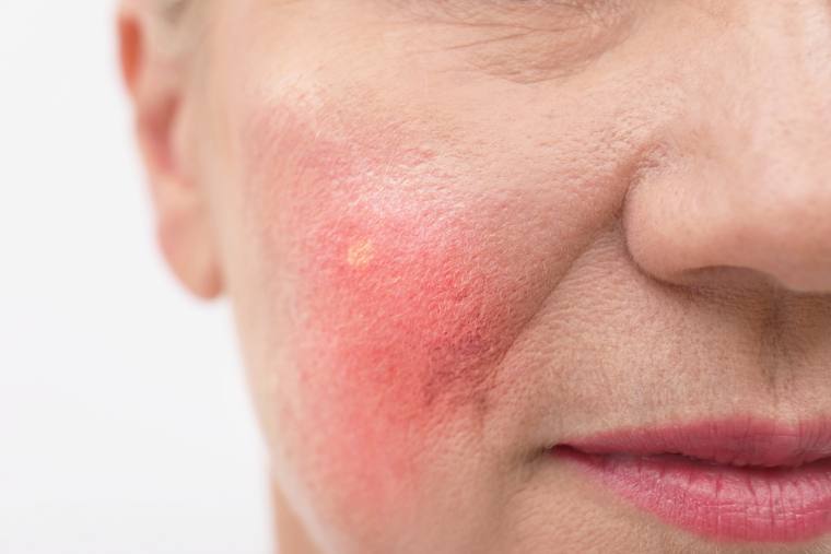 Rosacea