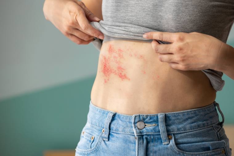 Shingles