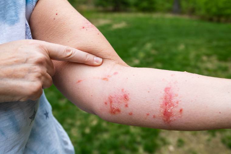 Skin irritation (contact dermatitis)