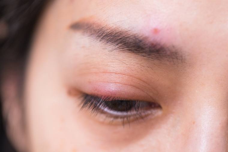 Stye